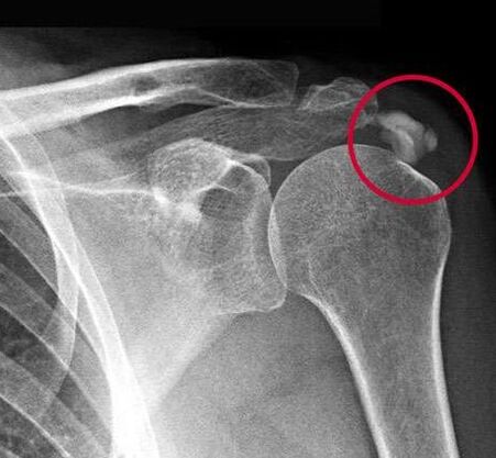 La radiografía mostró depósitos de sales de calcio en la articulación