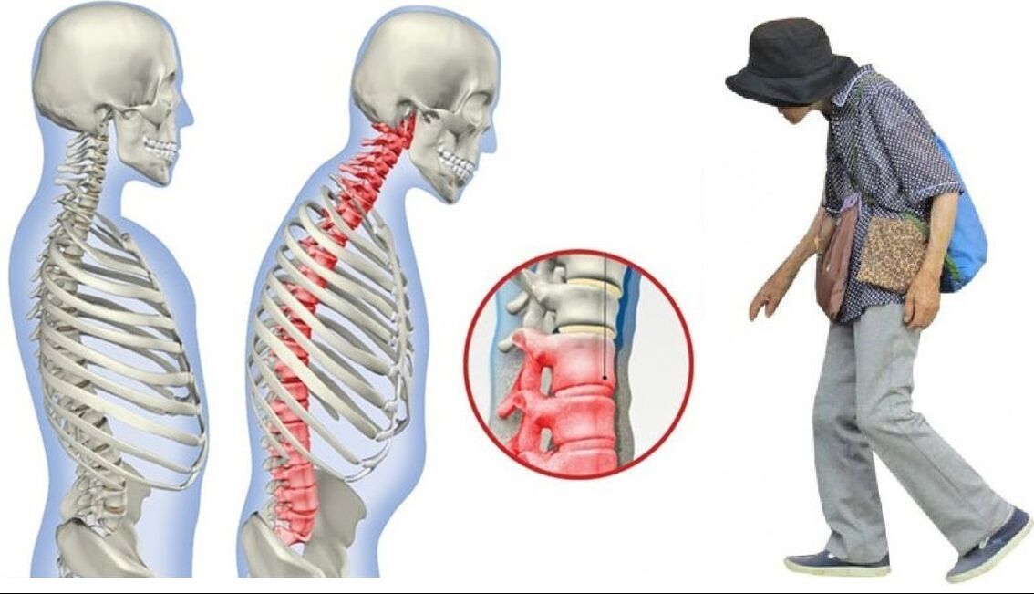 Dolor de espalda debido a espondilitis anquilosante.