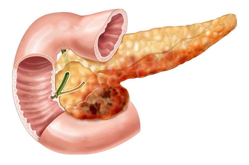 dolor de espalda debido a pancreatitis