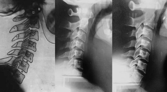 Cuello con un desplazamiento de la primera vértebra cervical