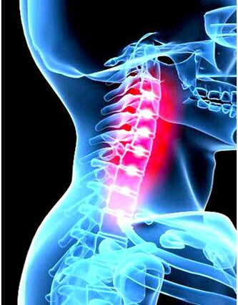 Imagen clínica de la osteocondrosis