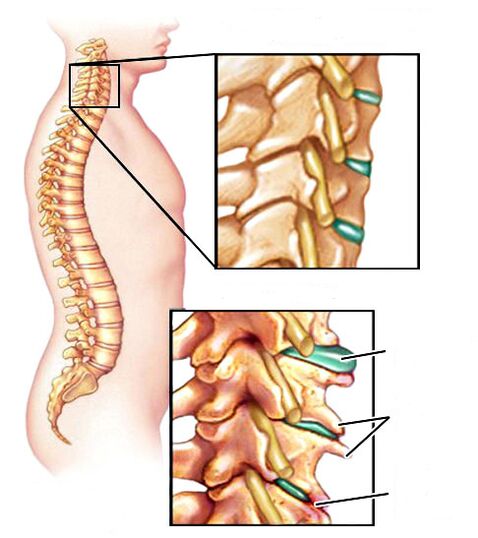 ¿Cómo se ve la osteocondrosis